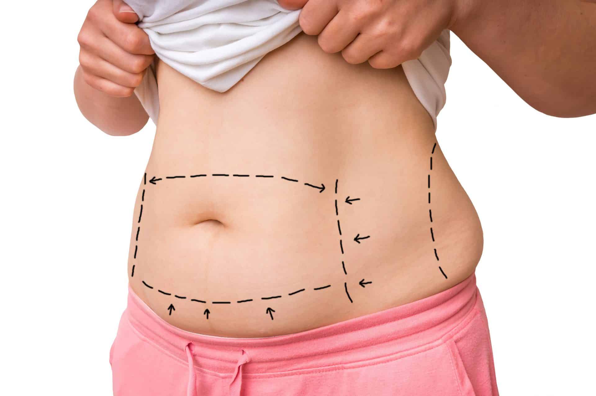 tout ce qu'il faut savoir après une abdominoplastie (plastie abdominale)